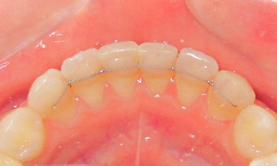 fixní ortodontický retainer